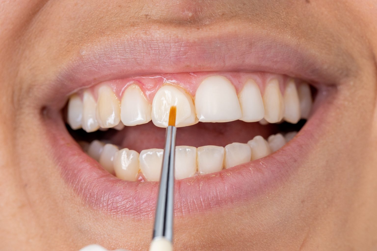 Kompozītmateriāla bondings